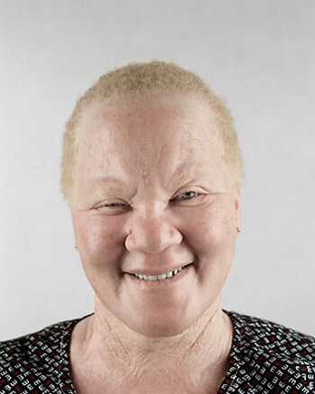 albinos-afrcanos-1
