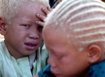 albinos-afrcanos-10