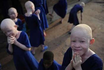 albinos-afrcanos-2