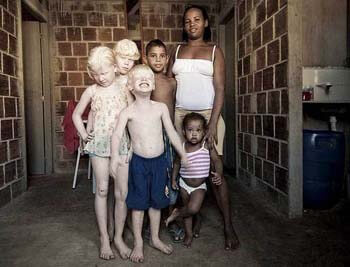 albinos-afrcanos-3