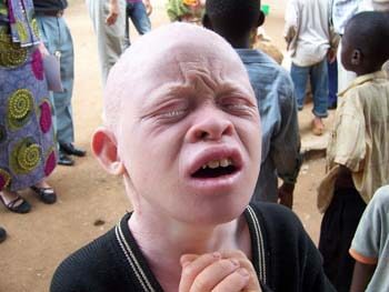 albinos-afrcanos-5