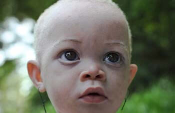 albinos-afrcanos-6