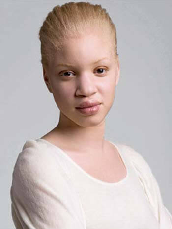 albinos-afrcanos-9