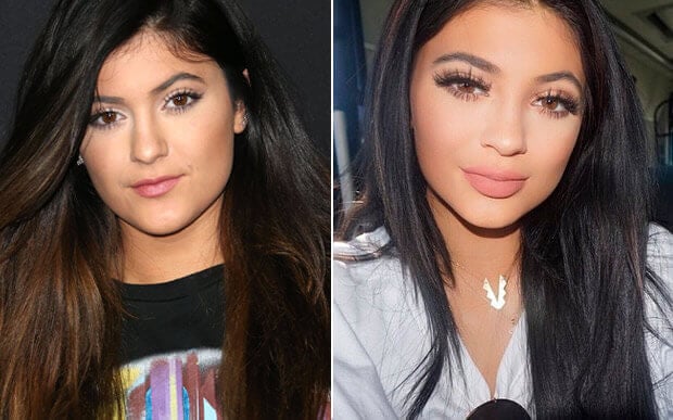 kylie-jenner-assume-que-fez-preenchimento-nos-labios61652
