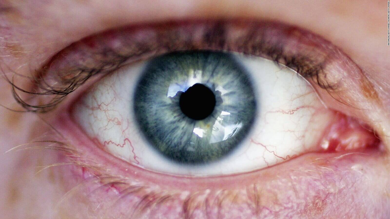 Os olhos podem denunciar a presença do HIV no organismo