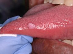 Sexo Oral Causa Mais Cancer de Boca Que Cigarro