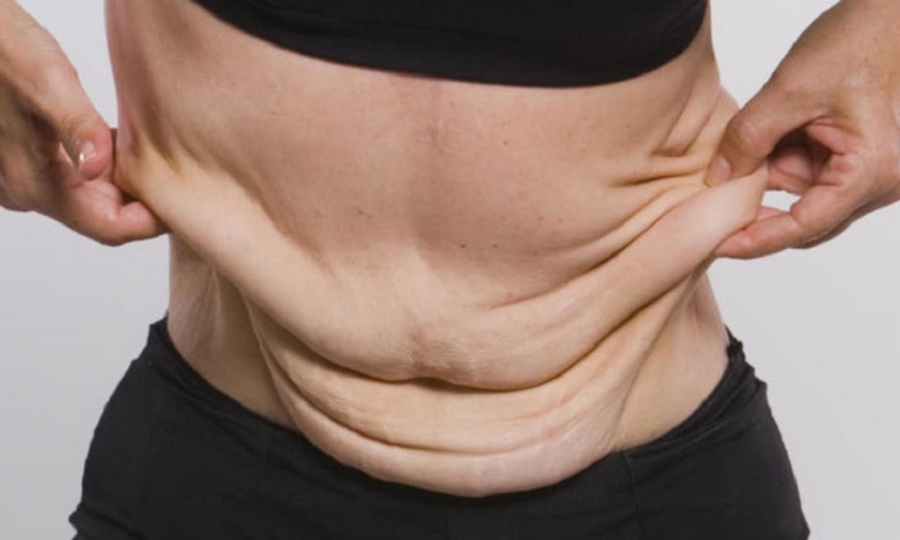 Cirurgia de contorno corporal pós-perda de peso maciça