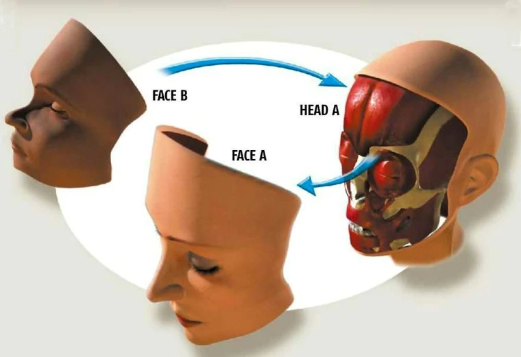 Transplante facial